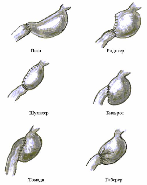 Варианты резекции желудка. Язвенная болезнь